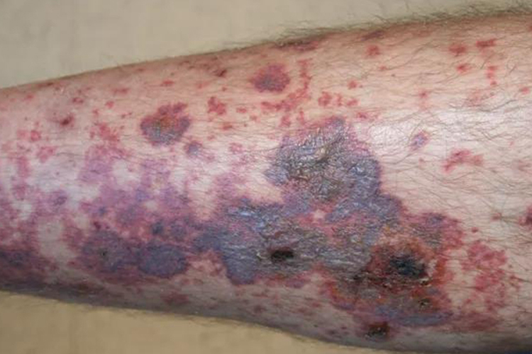 肝癌晚期皮下出血瘀斑图 肝癌晚期皮下出血瘀斑图