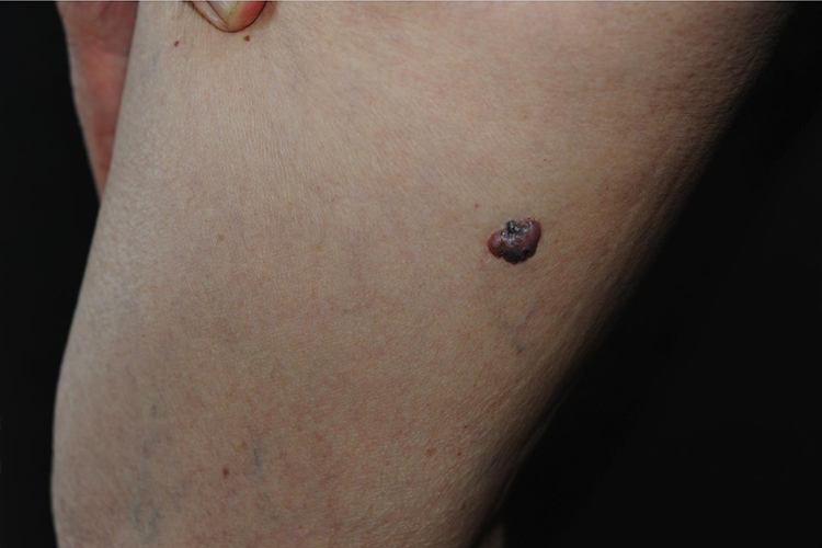 Pinkus纤维上皮瘤型基底细胞癌图