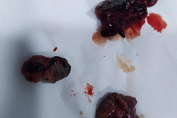 痔疮手术套扎脱落痔核图