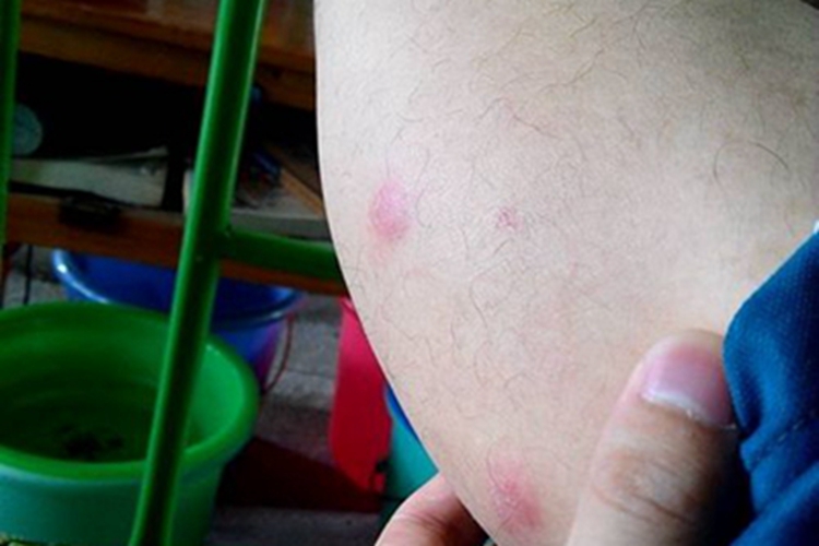 钩虫皮炎疙瘩图