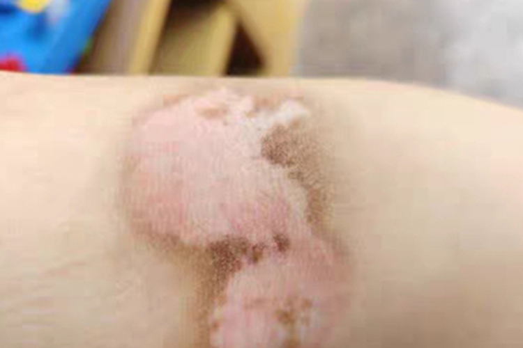 泛发型白癜风肘部症状图