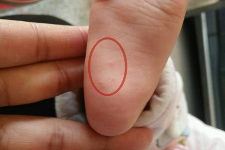 胃肠不好脚底有颗粒图