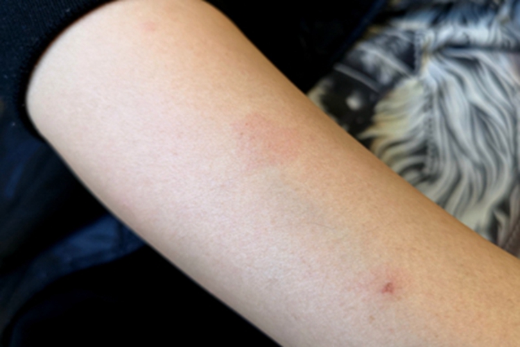 成人痒疹胳膊有一红斑图