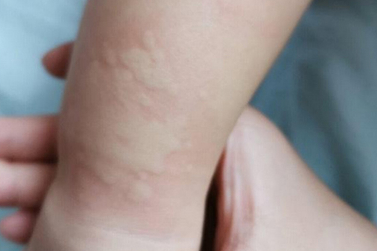 十个月宝宝过敏起风团图