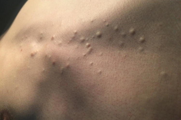 多发性皮脂腺囊肿锁骨症状图