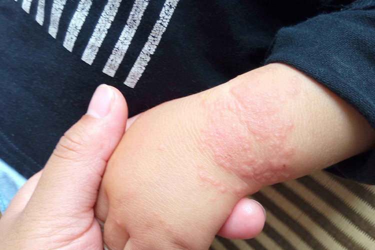 急性接触性皮炎轻微症状为边界清楚的红斑,其上有丘疹和丘疱疹,常自觉