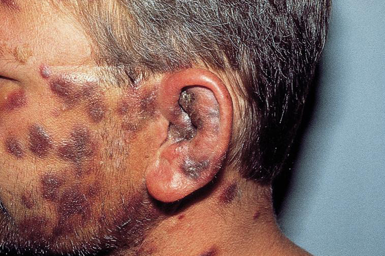 艾滋病面部卡波西肉瘤图