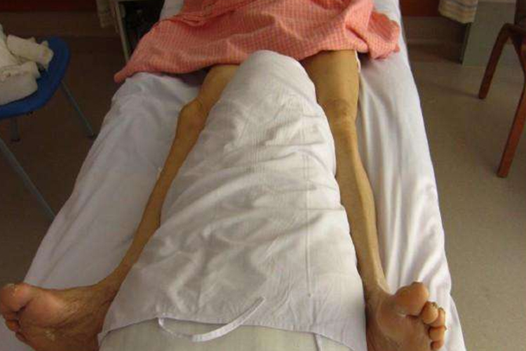 股骨转子间骨折护理体位图