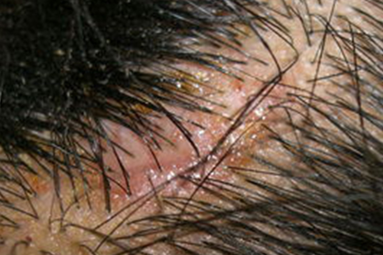 婴儿脓疱性栗粒疹图 婴儿脓疱性栗粒疹图