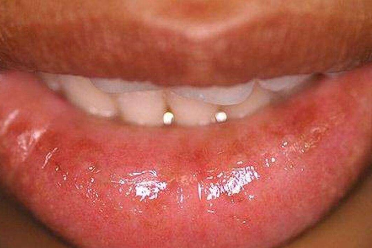 单纯性腺性唇炎图