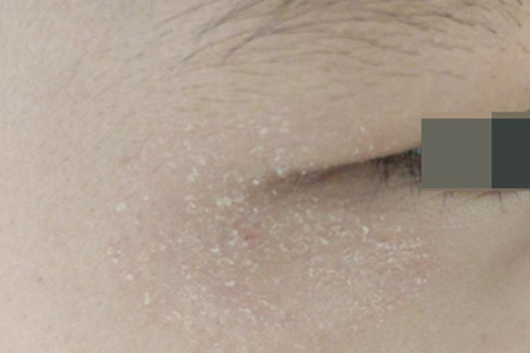 成人脂溢性皮炎眼周症状图