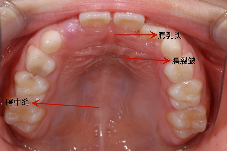 口腔上颚内壁正常图片