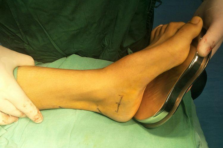 轻度高弓足图 轻度高弓足图