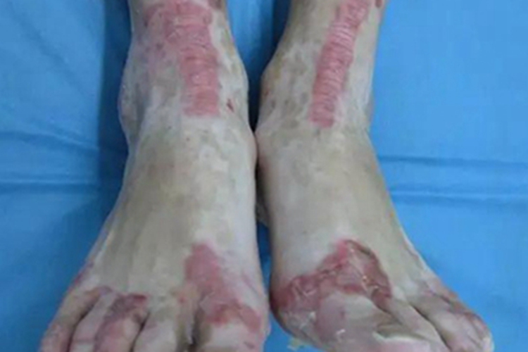 肠病性肢端皮炎脚部脱皮红斑图