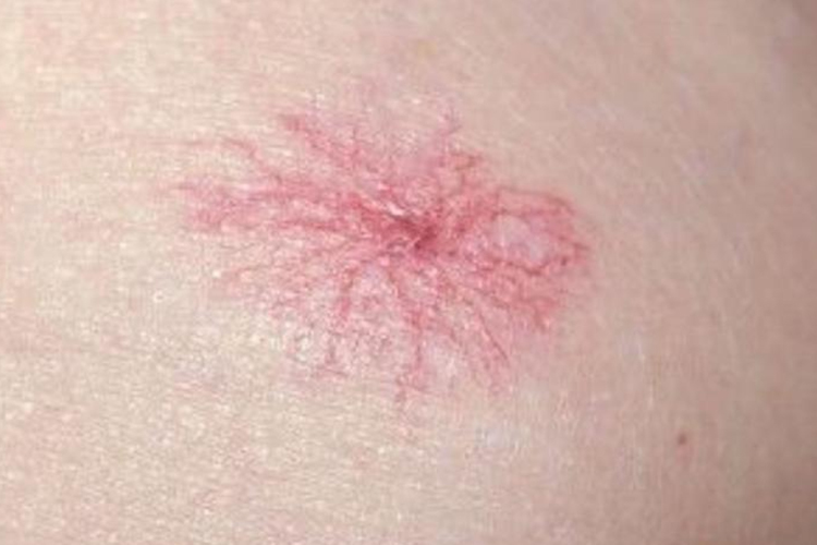 毛细血管畸形图