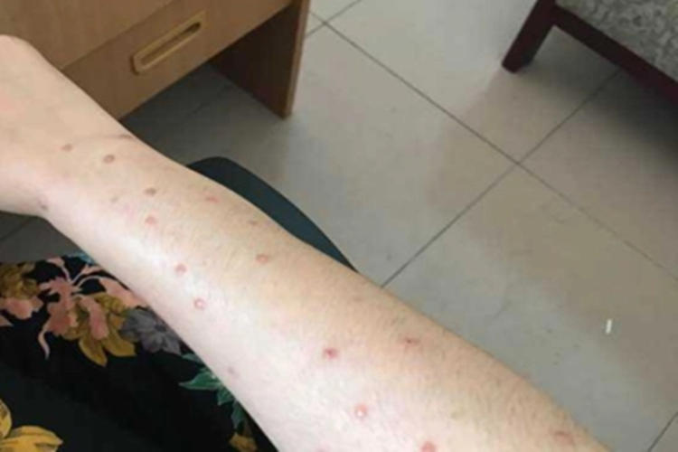 单纯性痒疹胳膊症状图 单纯性痒疹胳膊症状图