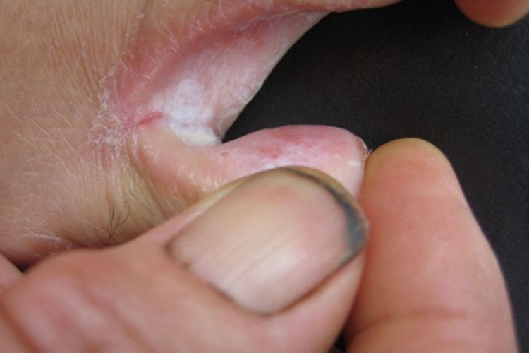 浸渍糜烂型足癣图