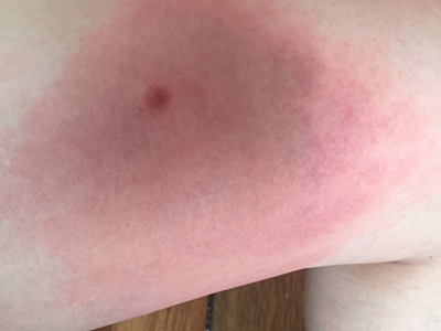 蜘蛛蜇伤大腿内侧大片红斑中间有红点图.jpg