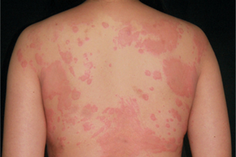 荨麻疹型药疹背部风团图