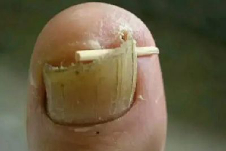 慢性甲沟炎甲松动脱落图