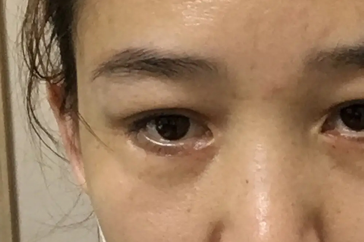 外切眼袋增生鼓包图