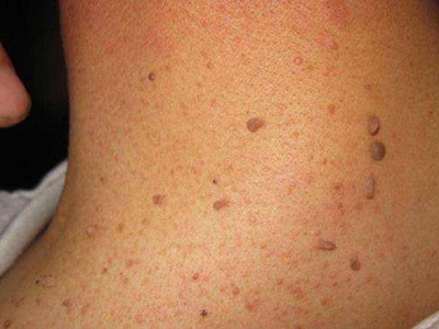 软纤维瘤颈部肉赘图