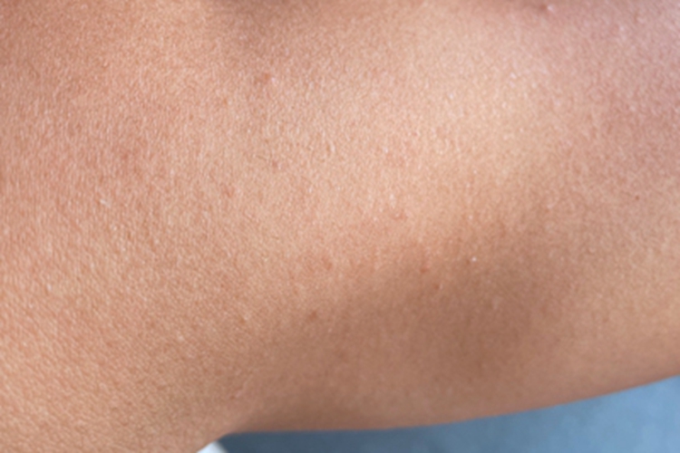 早熟性皮脂腺增生胳膊小疙瘩图