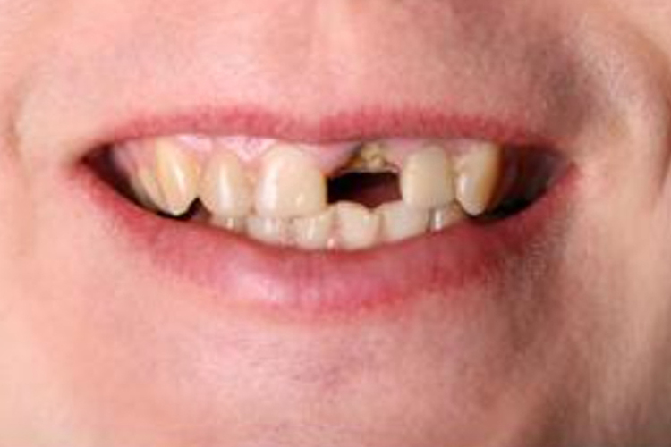 门牙嵌体修复前图