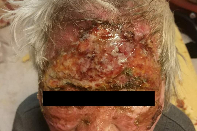 深Ⅱ度烧伤面部红肿图