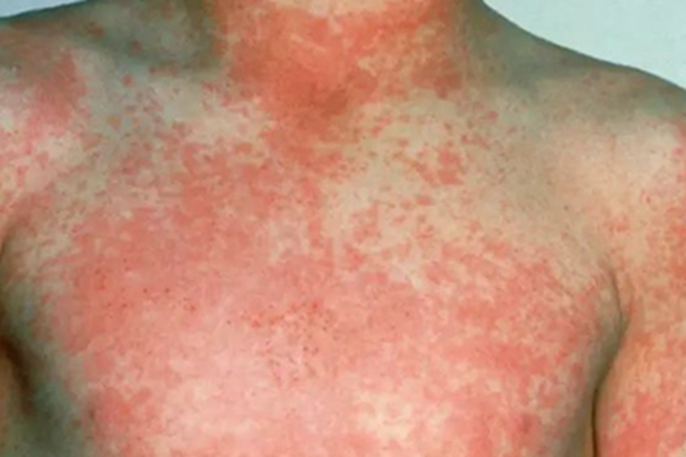 登革热胸部症状图