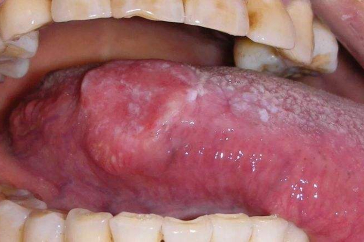 舌头边缘创伤性溃疡图
