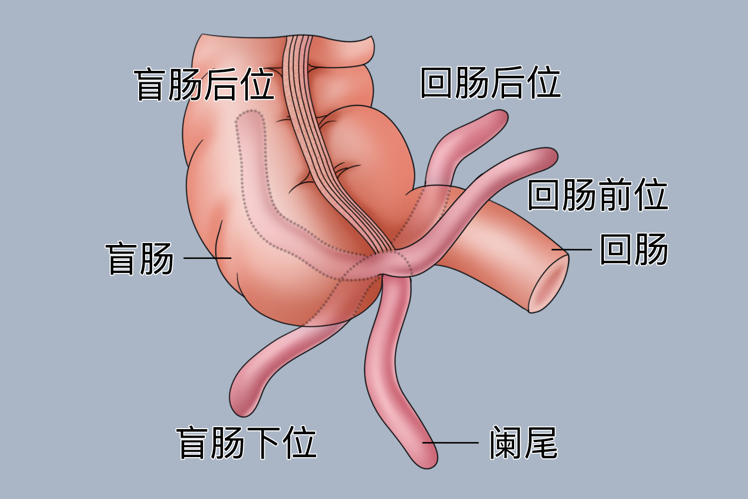 异位阑尾图 异位阑尾图