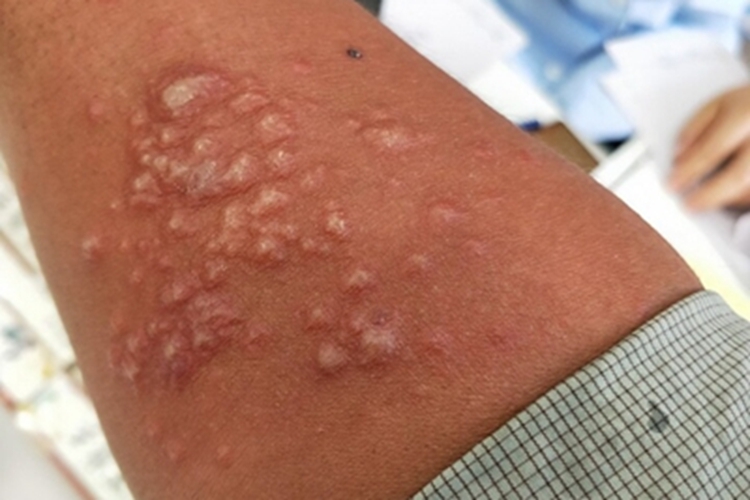 单纯皮肤型原藻病胳膊疙瘩图 单纯皮肤型原藻病胳膊疙瘩图