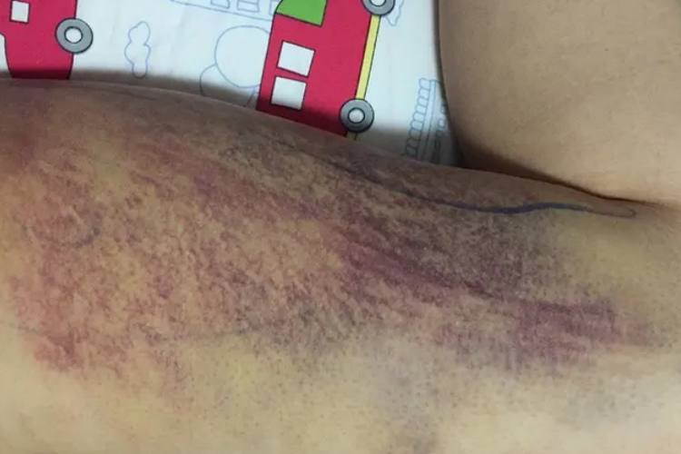 脂肪抽吸术肿样图 脂肪抽吸术肿样图