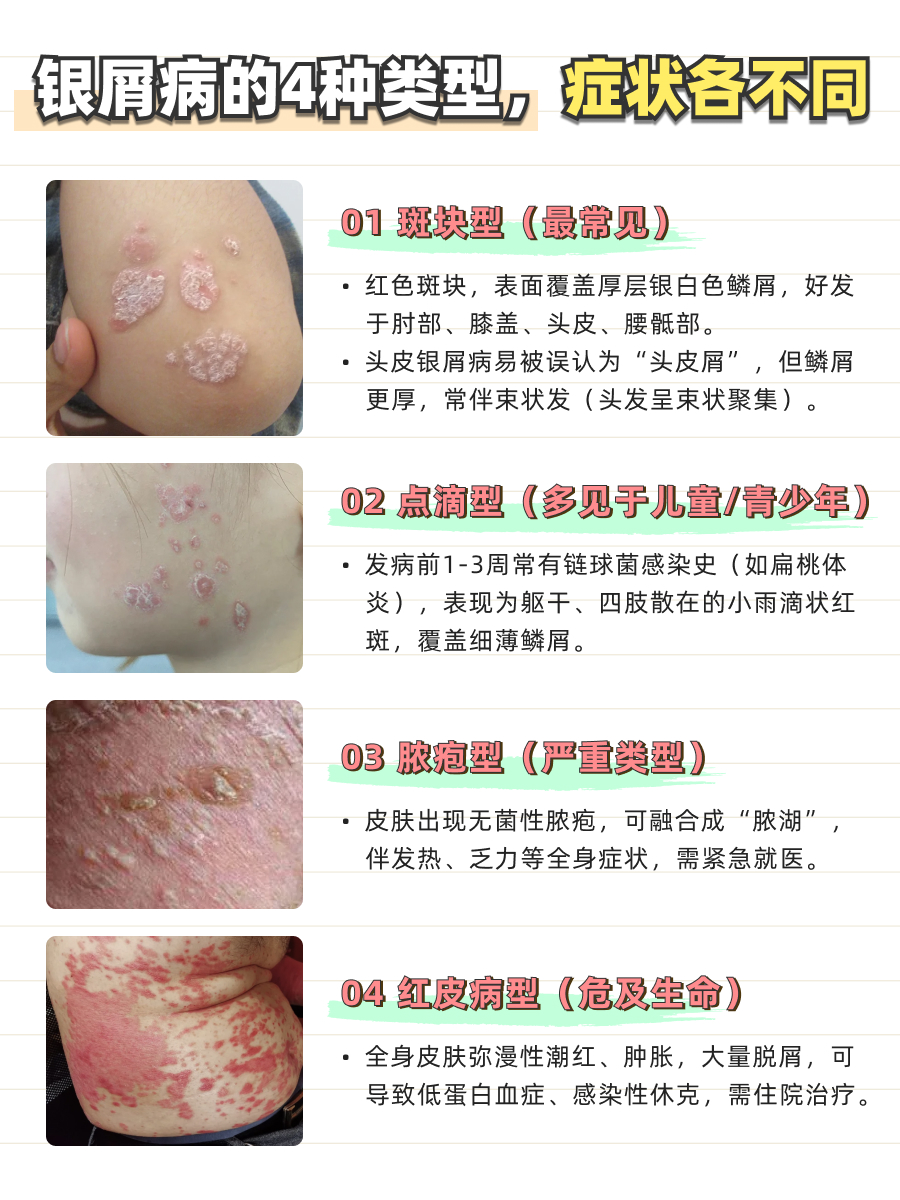 皮肤科医生辟谣！牛皮癣根本不是 “癣”！