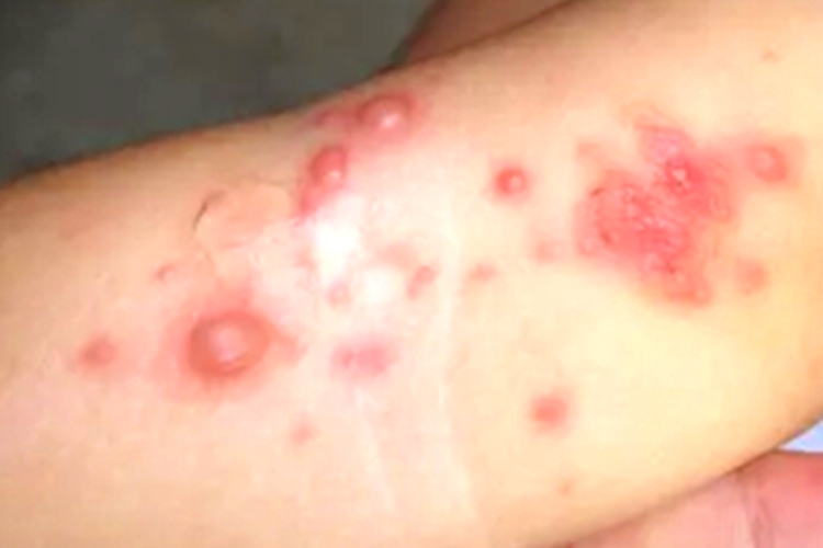 幼年型类天疱疮胳膊红斑图