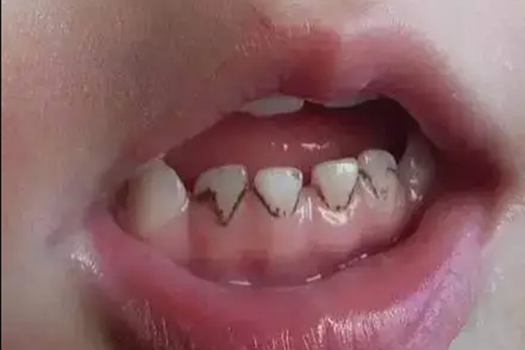 儿童龈下菌斑图 儿童龈下菌斑图