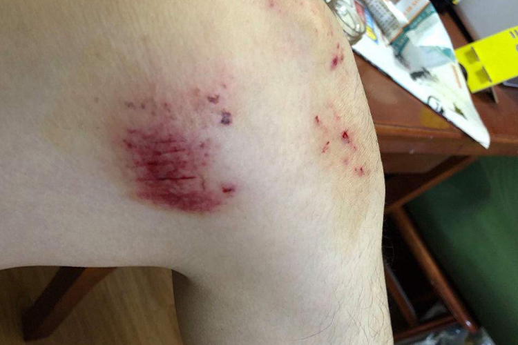 女生腿摔伤流血图