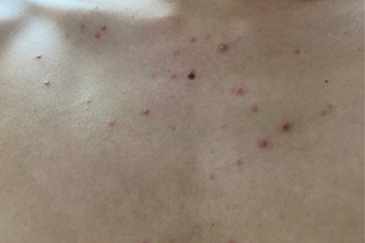 毛囊炎胸部症状图 毛囊炎胸部症状图