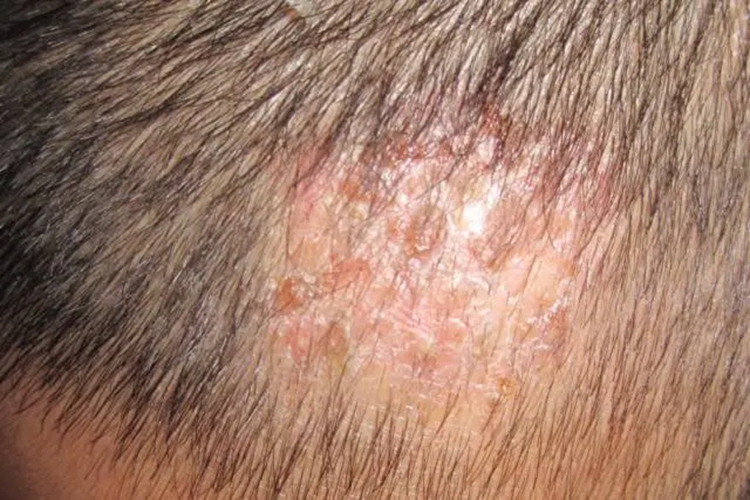 结痂型脂溢性皮炎图