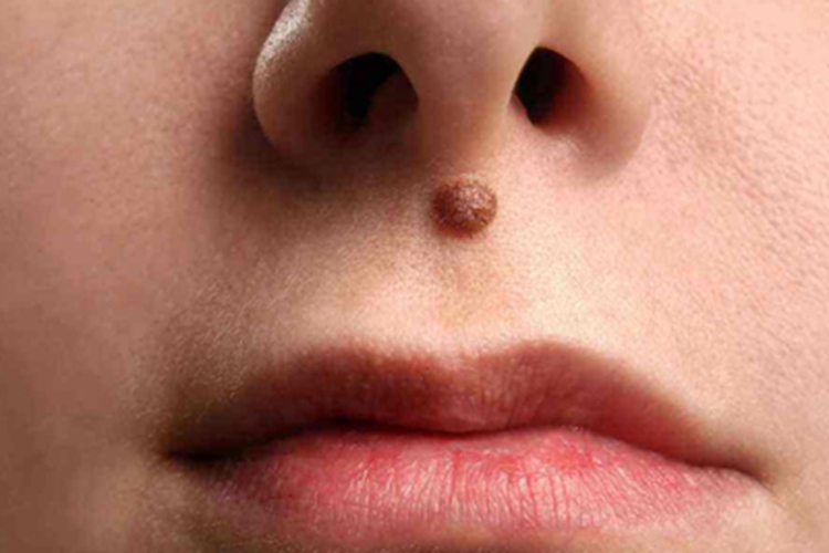 单发性有蒂软纤维瘤面部症状图 单发性有蒂软纤维瘤面部症状图