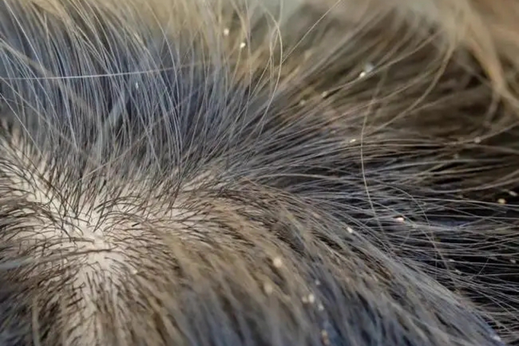 虱子主要表现为被叮咬的皮肤出现丘疹,瘀点,自觉头皮瘙痒,在头发上可