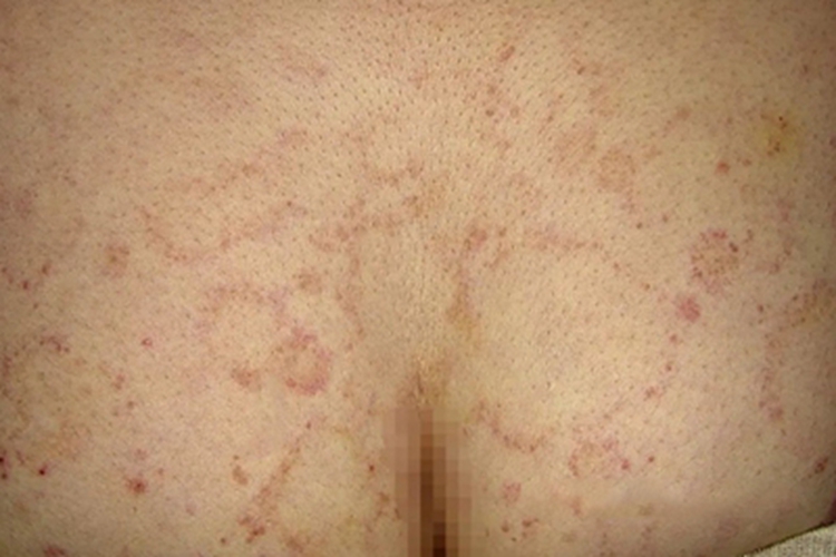 离心性环状红斑臀部红斑图