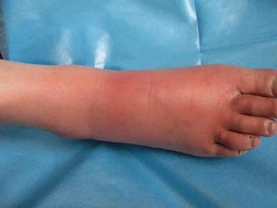 急性网状淋巴管炎的症状和图片 - 有来医生