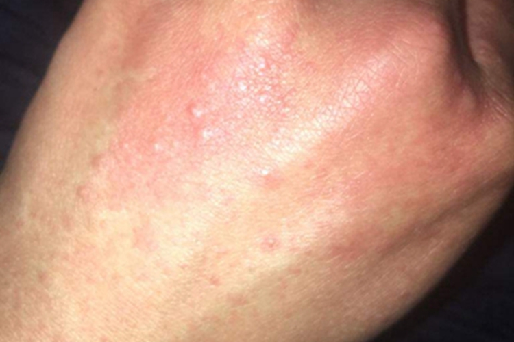 柯萨奇湿疹手背症状图