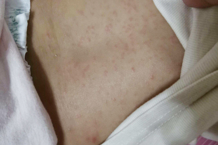 背部幼儿急疹图
