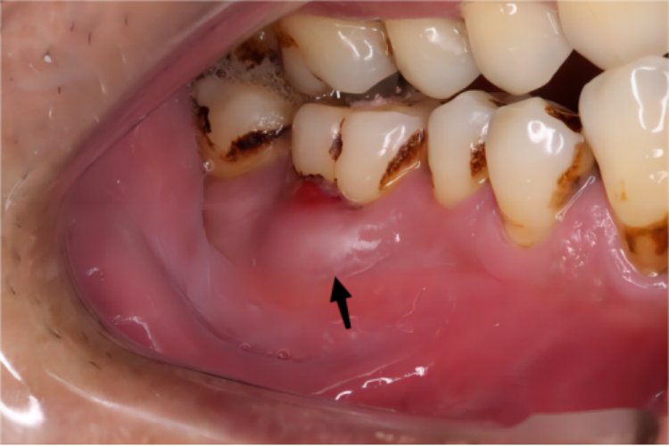 牙周脓肿脓包图
