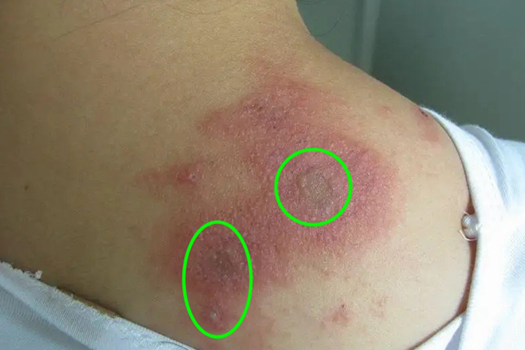 皮肤过敏红肿背部水疱图 皮肤过敏红肿背部水疱图