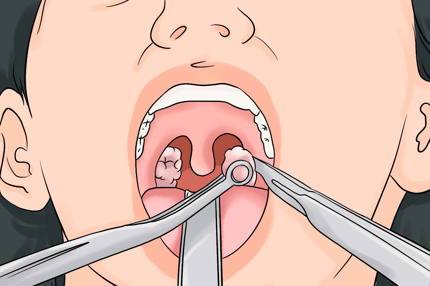 腺样体切除器切除图