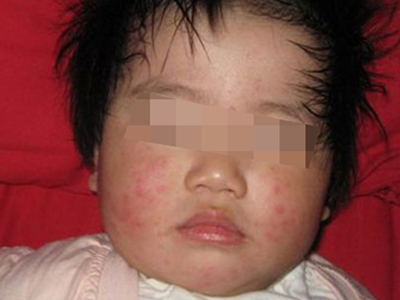 获得性风疹出疹期脸上长红疹子图.jpg